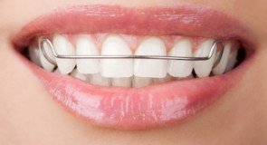 Come correggere i denti storti con gli apparecchi fissi e mobili
