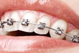 Ortodonzia e ortodontista: cos’è e di cosa si occupa.