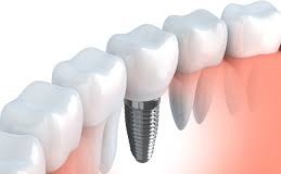 Nuove tecnologie per la cura dei denti