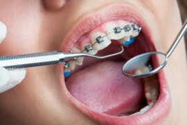 Ortodonzia: tutto quello che devi sapere sui denti e il loro allineamento