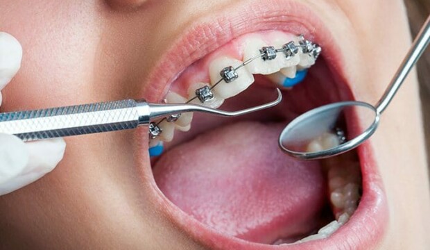 Ortodonzia: tutto quello che devi sapere sui denti e il loro allineamento