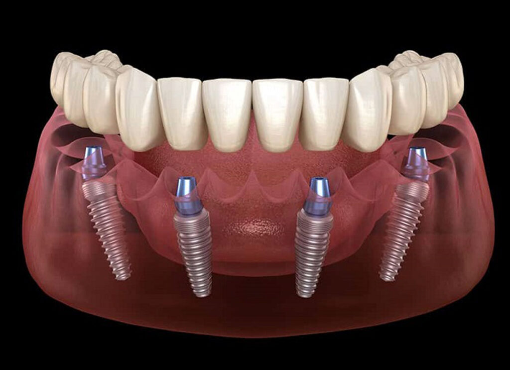 impianti-dentali