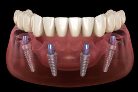 Impianti Dentali: Una Soluzione Moderna per il Sorriso Perfetto